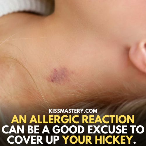 An allergic reaction can be a good excuse to cover up your hickey
